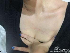 胸受伤图片  第2张